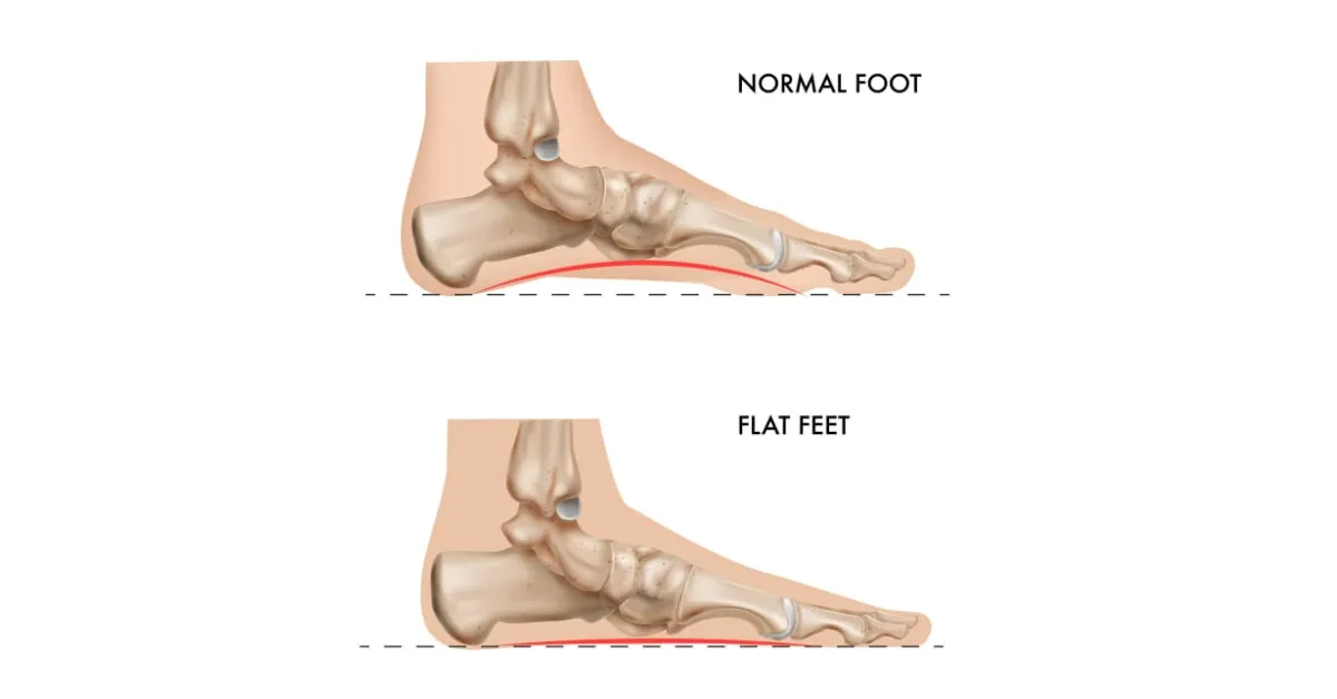 Flat Feet